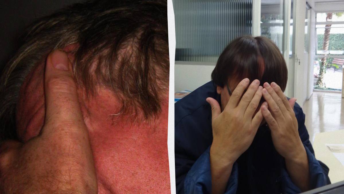 Split image: left—reddened sunburned neck/ear; right—a person hiding their face with hands outdoors indoors.