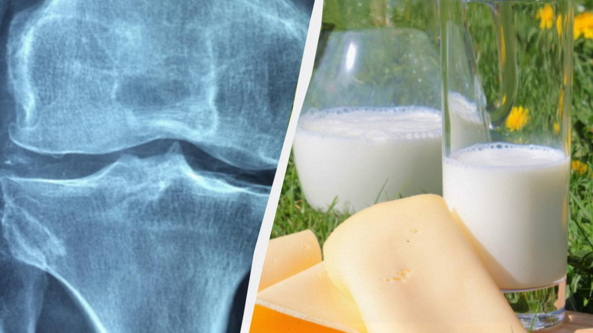 Split image: left side shows a knee joint X-ray, right side shows milk and cheese outdoors on grass with a glass bottle nearby.