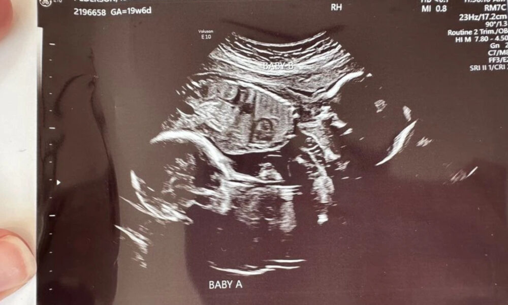 Ultrasound image of fetus labeled Baby A, showing a side profile with head and torso visible.
