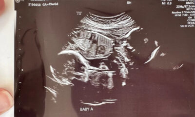 Ultrasound image of fetus labeled Baby A, showing a side profile with head and torso visible.