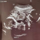 Ultrasound image of fetus labeled Baby A, showing a side profile with head and torso visible.