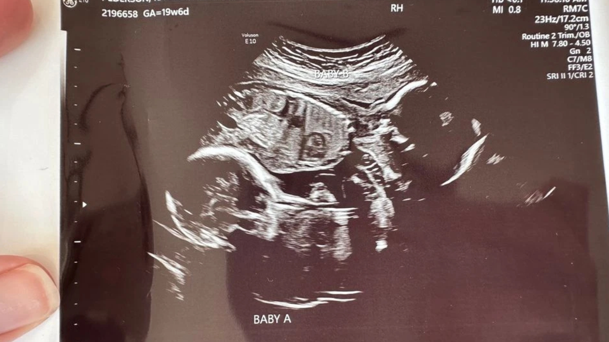 Ultrasound image of fetus labeled Baby A, showing a side profile with head and torso visible.
