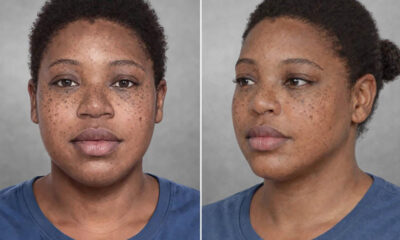 Before-and-after comparison of a young woman showing reduced facial freckles; left is before, right is after treatment. she wears a blue shirt with a gray studio backdrop.