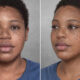 Before-and-after comparison of a young woman showing reduced facial freckles; left is before, right is after treatment. she wears a blue shirt with a gray studio backdrop.