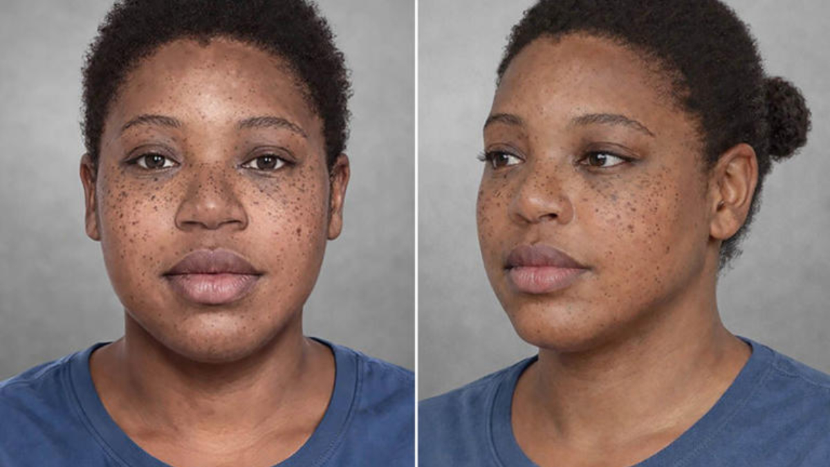Before-and-after comparison of a young woman showing reduced facial freckles; left is before, right is after treatment. she wears a blue shirt with a gray studio backdrop.