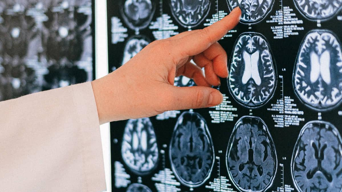 Doctor's hand points to a brain MRI scan on film, highlighting a specific region on the image.